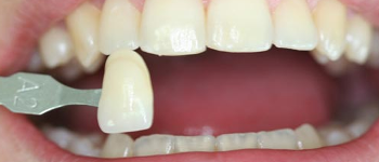imagen-carillas-dentales